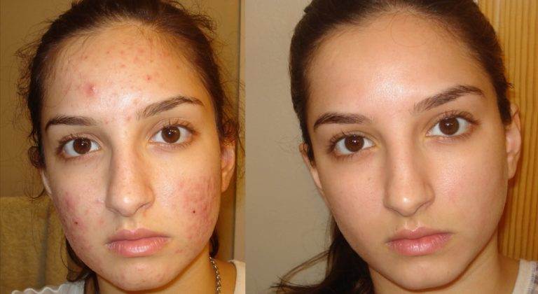 Before and After Acne Treatment Services, Beauty Land Services, BC