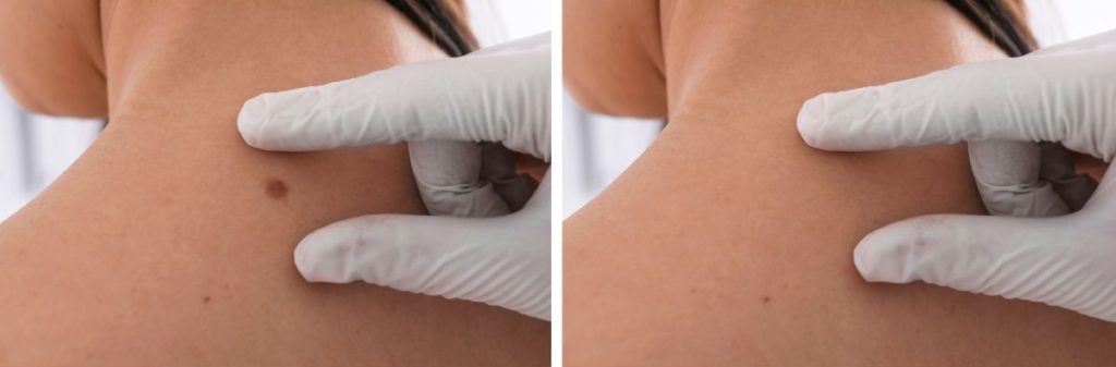 beautyland hair and beauty salon bridal Mole and Wart removal